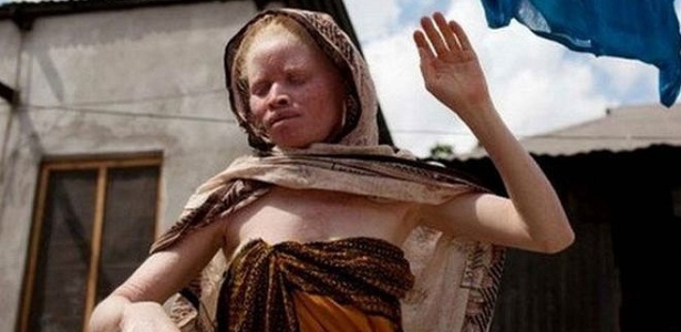 Na Tanzânia, pessoas albinas sofrem sequestros e são até assassinadas por sua condição