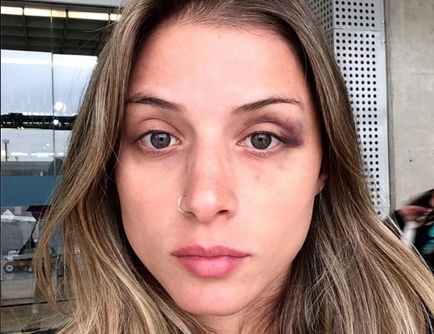 Angela Sousa mostra hematoma no olho, causado por suposta agressão do namorado Yuri. Foto: Divulgação 